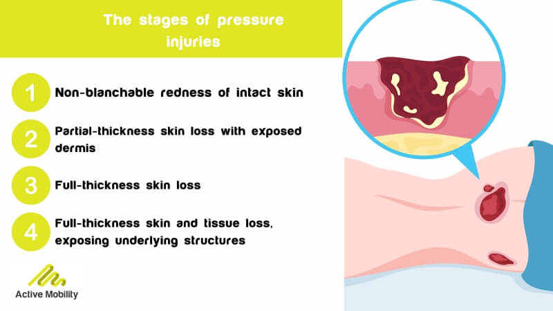 The stages of pressure injuries